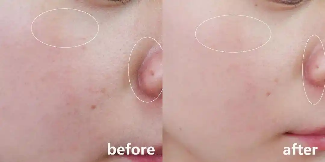 上图为敏敏连续叠加两款精华用了一个月的皮肤状态的差异,使用前的