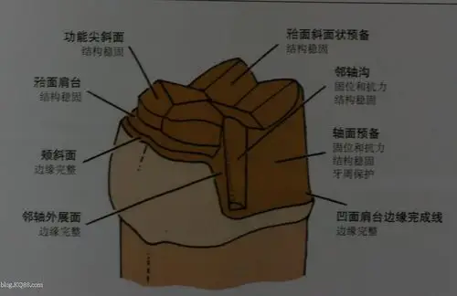 嵌体有效提高产值和远期疗效的治疗方法原创