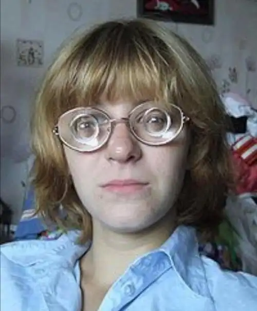 高度近视会导致的很多病发症,度数600多的人必看!_眼睛