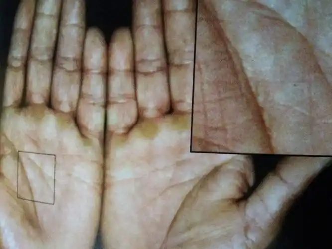 肝区掌色的改变与肿瘤有什么特殊关系