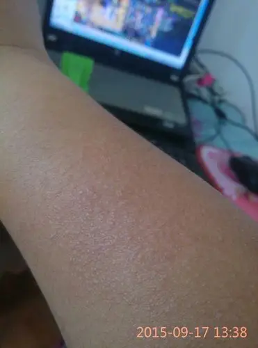 去年得了日光性皮炎,之前是被晒过的地方都痒,最近阳光不太大,胳膊上