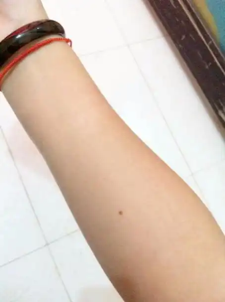 右手手臂有痣,如图,怎么去掉?