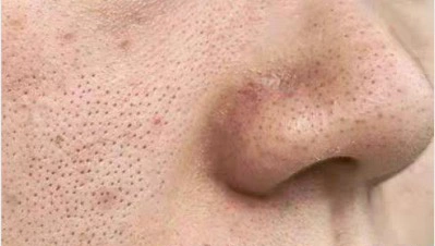 解决原理主要是疏通毛孔,深层清洁,清理掉堵塞的东西,可以