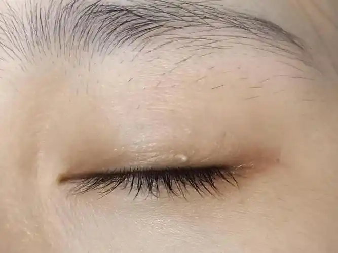 眼皮上长了一个颗粒 是脂肪粒吗