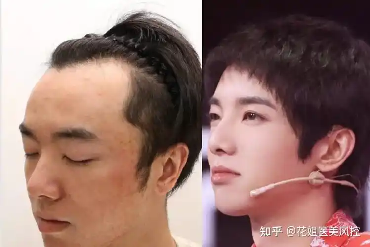 华晨宇是的我做发际线了