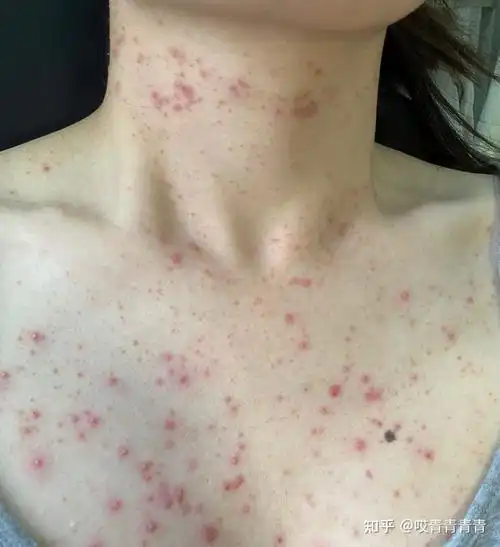 糠秕孢子菌毛囊炎(马拉色菌毛囊炎)个人治疗经历 - 知乎