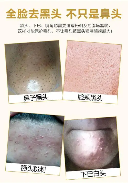 撕拉面膜脸部去黑头粉刺深层清洁收缩毛孔堵塞污垢排毒涂抹式套装