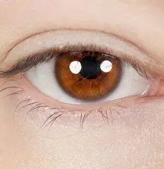 如用额肌瓣法矫正重度的上睑下垂,用上睑提肌缩短