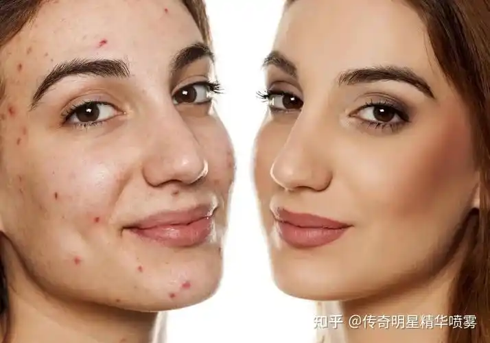 熬夜党最重要中招的这4个皮肤问题有救了