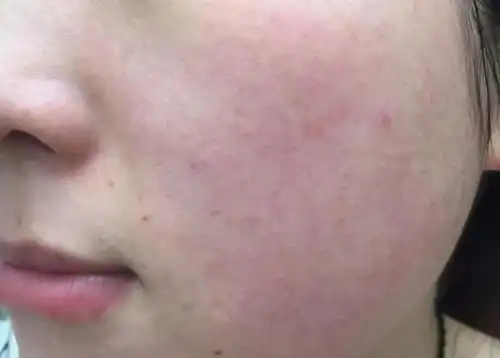 红血丝超详细的解析_皮肤