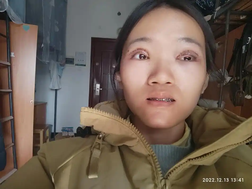 day2双眼皮手术第二天照片.#全切双眼皮 #双眼皮修复 # - 抖音