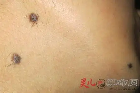 为什么痣上的毛不能拔