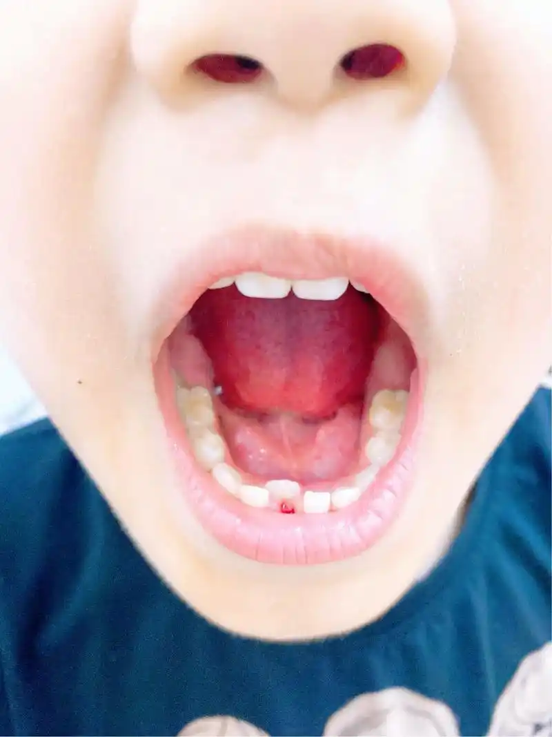 双排牙.牙齿缺乏锻炼:若幼儿的饮食过于精细,幼儿的咀嚼对颌骨 - 抖音