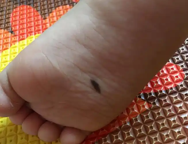 医生提醒:若黑痣长在这4个位置,一定要密切关注,及早做检查