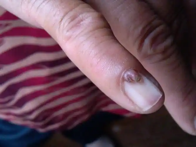 最近见的一例手指甲赘生物