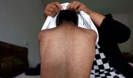 6岁男童全身长满黑毛 脖子凸起黑肉体重只有30多斤