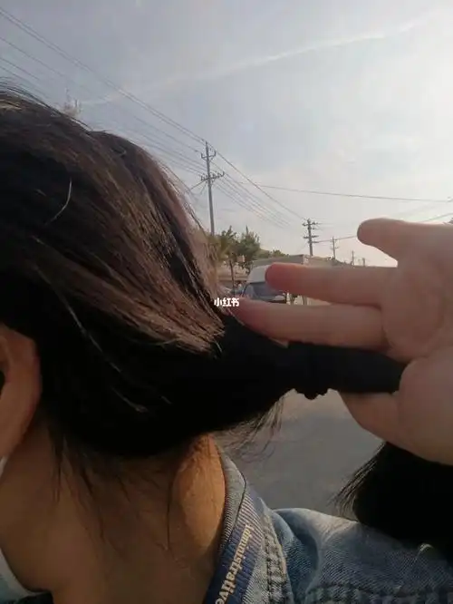 才33岁头发剩这么一小绺儿