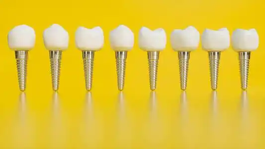 种植牙齿图片-种植牙齿素材-种植牙齿插画-摄图新视界