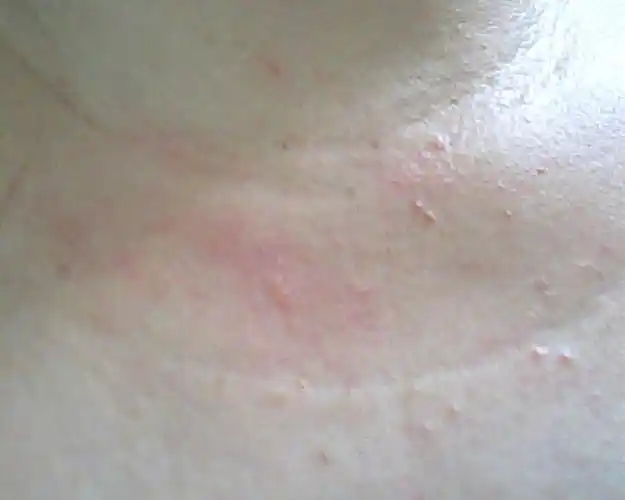 脖子下方,曾经有扁平疣,在医务室让医生挤了之后,出现许多像红色突起