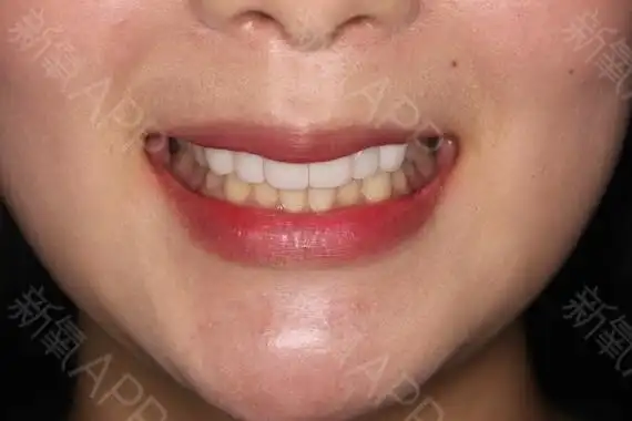 虎牙又叫犬齿,是一种常见的畸形牙,指唇侧错位的尖牙_圈子-新氧美容