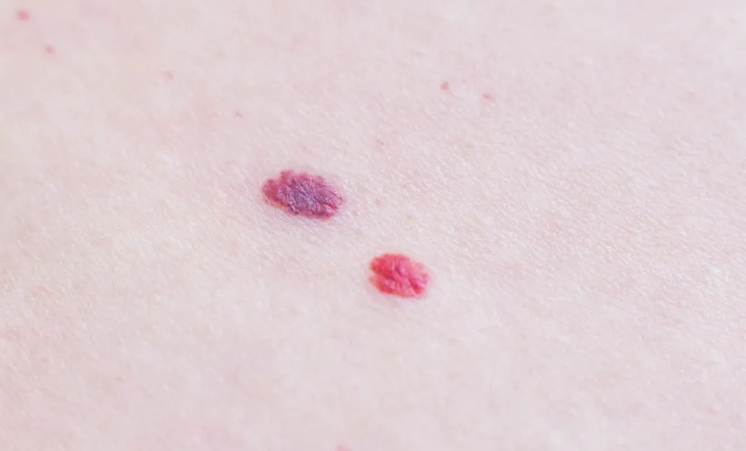 身上长红痣是什么原因湿气重的小红点图片