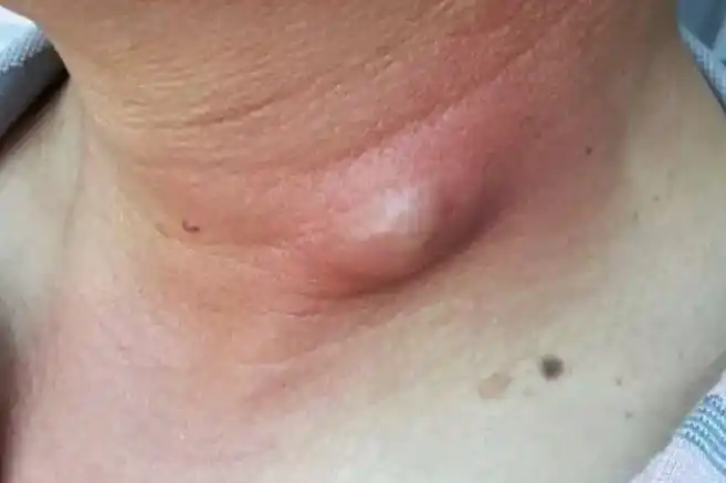 孕妇脖子上长小肉疙瘩图片_图文_文章_美咯_让您放心美!