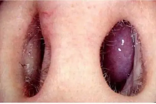 如果有的医生愿意看一下鼻腔的话,鼻粘膜苍白,发灰,甚至变蓝以及鼻甲