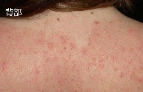 100种皮肤病对照表-皮肤病对照大全-名医汇