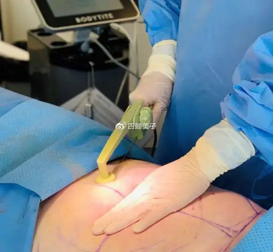 梳理腰腹环吸后1到7天图片终于搞懂了水动力和威塑吸脂哪个好