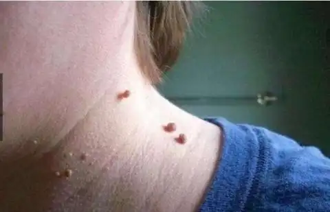 脖子上出现了丝状疣怎么办