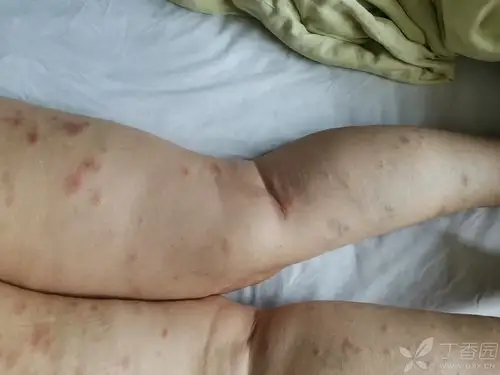 各位大神看看这些照片是什么皮肤病,谢谢 [病例帖]