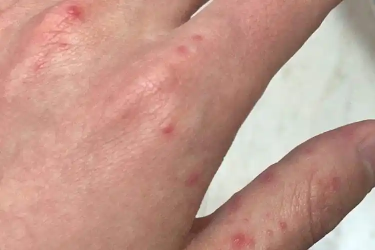 大人手足口病手部疱疹图