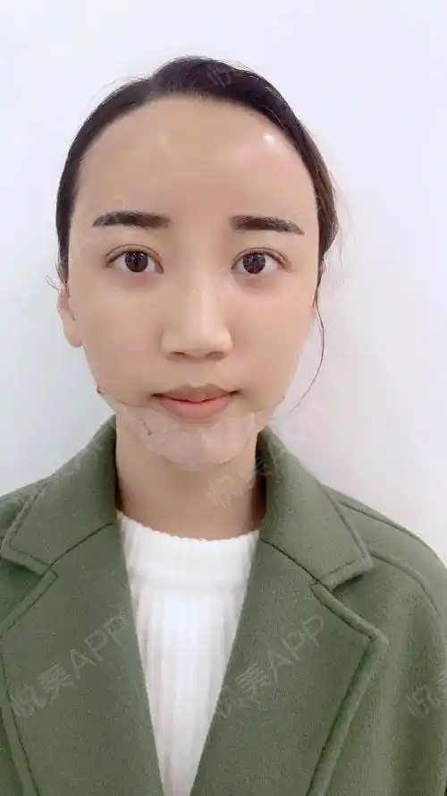 术后效果马上出来了,脂肪填充额头还是有点肿肿的,整个额头到眼睛下面