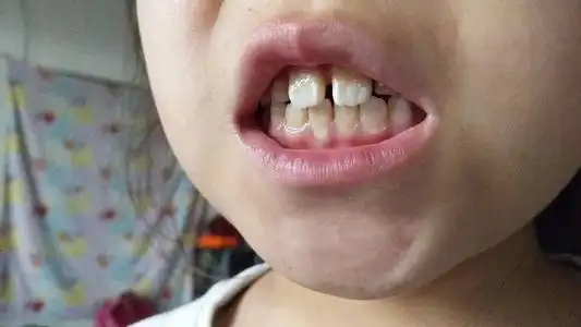 三.帮孩子纠正咬手指的坏习惯