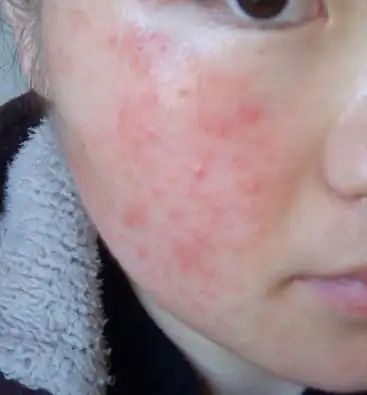 脸上过敏全是红痘痘,有时还发烫,应该是化妆品过敏了~ 哪们高手帮帮我