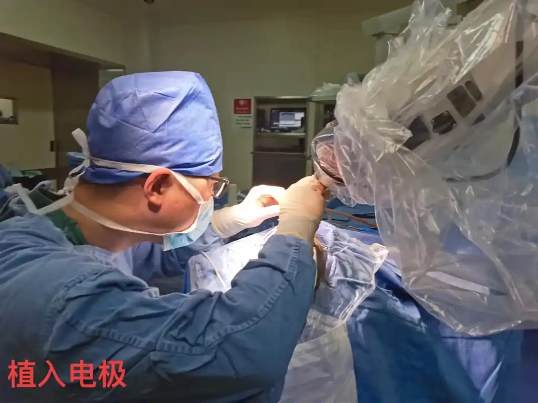 天坛医院功能神经外科机器人导航脑深部电极植入术,用于治疗帕金 - 抖