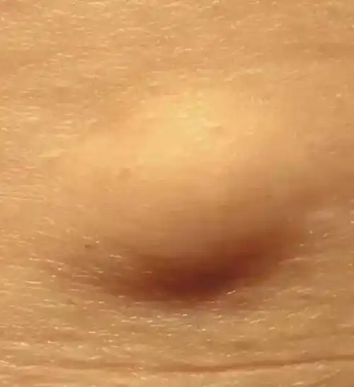 永医科普 | 脂肪瘤和脂肪肉瘤的区别