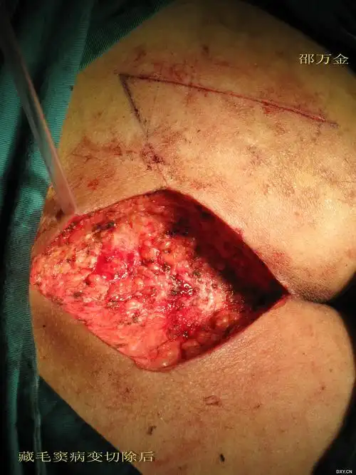 【原创】藏毛窦切除菱形皮瓣成型术(改良limberg手术) [精华]