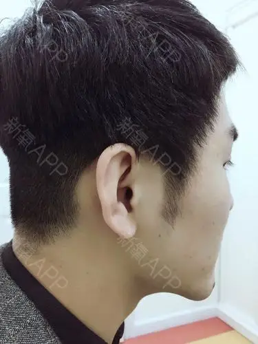 今天是我做疤痕种植还有鬓角种植的第9天,现在我的鬓_圈子-新氧美容