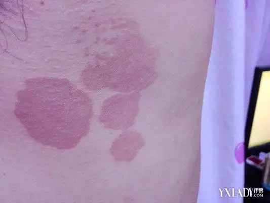 一些腋下长褐色圆斑图片这种情况怎么预防和护理