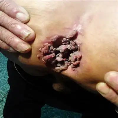 尖锐湿疣图片_尖锐湿疣症状表现图片大全_有来医生