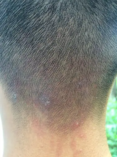 后脑勺红斑,不抠也不痒.请问谁知道是什么原因么?有什么治疗方法?