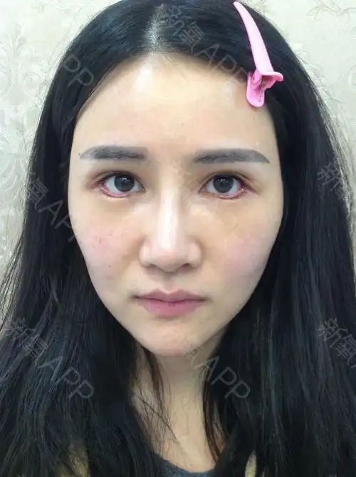 【下眼睑下至 开外眼角——术后第七天】