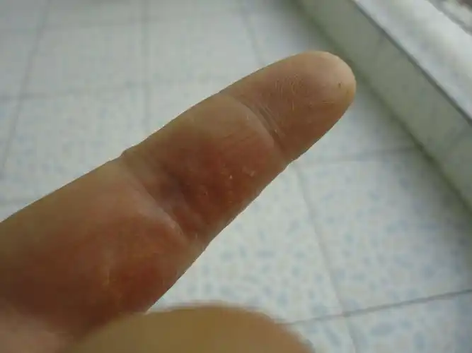 双手指顽固性湿疹