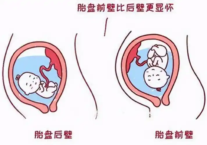 我们常见的胎盘位置只要有胎盘前壁和胎盘后壁两种,胎盘前壁就是指