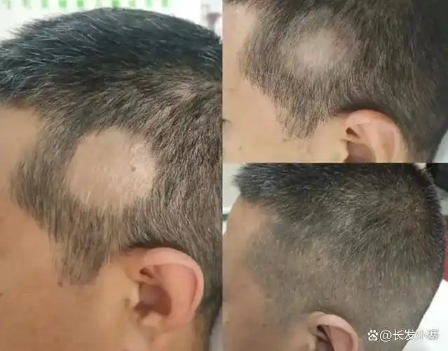 脱发头皮屑头皮人的第二张脸还不重视吗