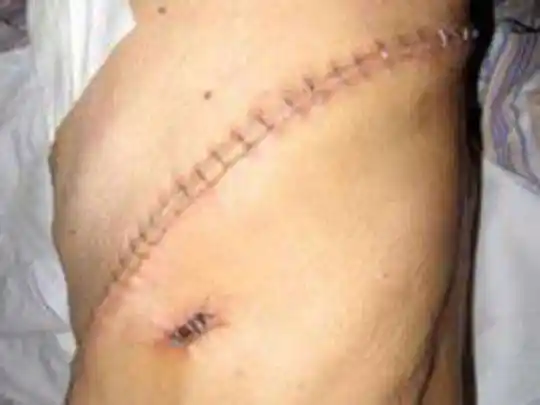 切口大多在20厘米以上,需撑开或剪断肋骨或者电锯劈开胸骨,手术创伤大