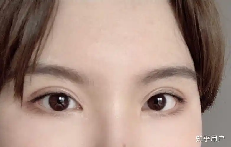 有没有割欧式双眼皮成功案例?