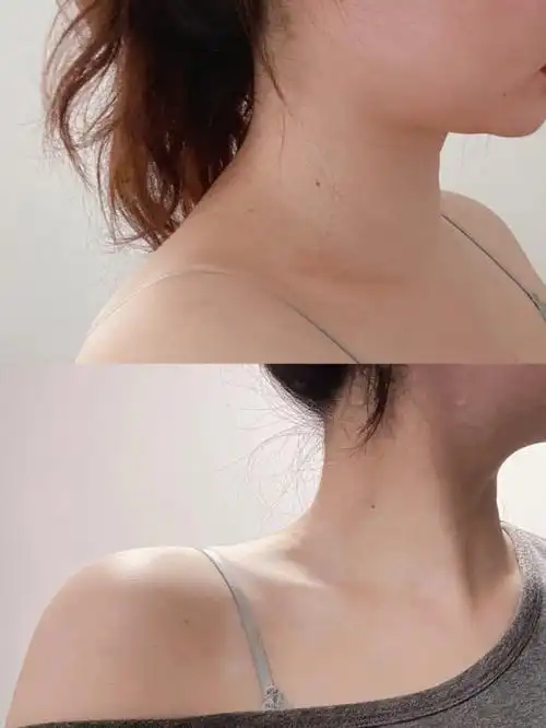 消除斜方肌厚厚的后背肉拉伸版