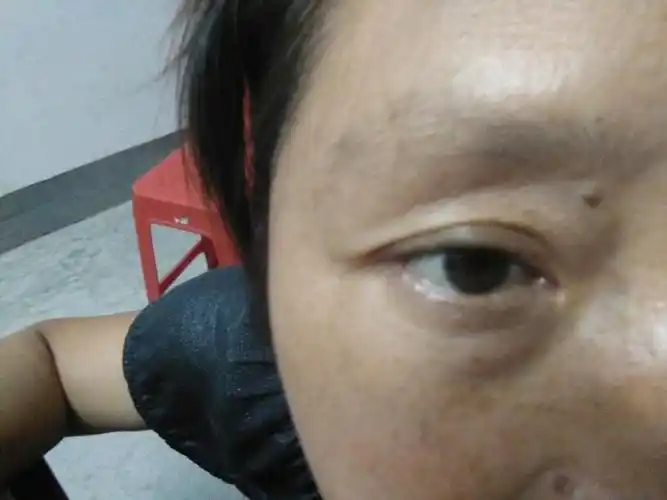 我妈眼睛下面也就是眼袋下面肿起来了怎么回事,有什么办法消下去